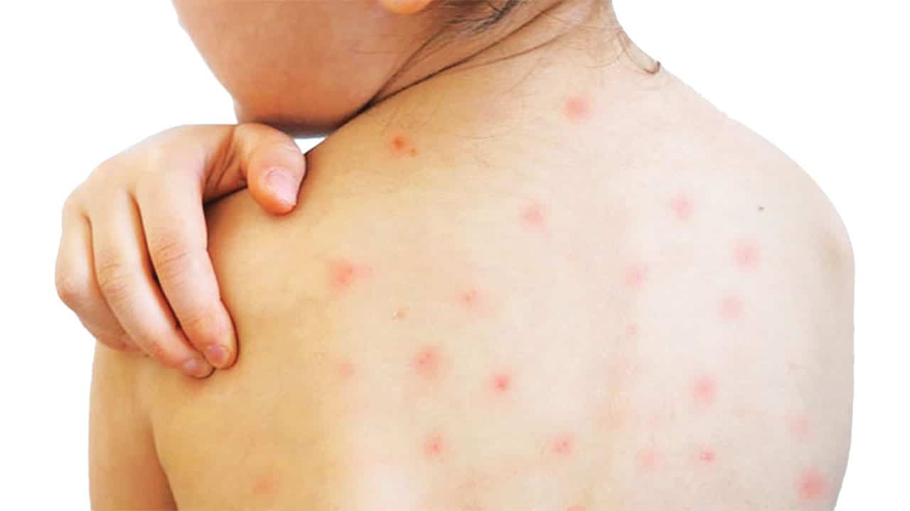 হামের উপসর্গে আরও ১০ শিশুর মৃত্যু